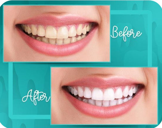 Starlet LED Blue Light Therapy Mouthpiece