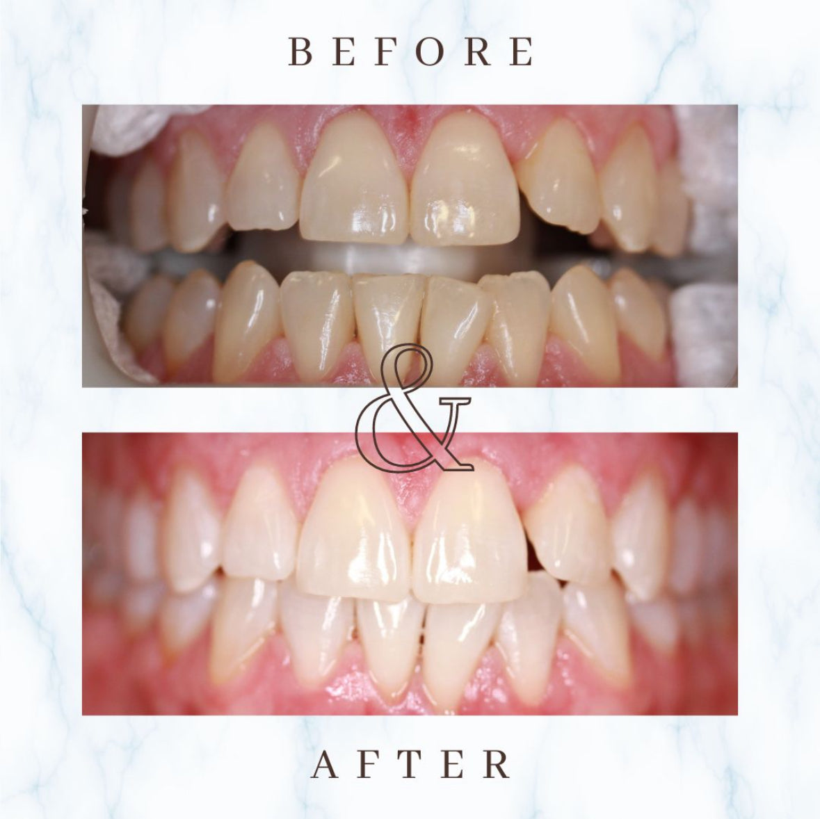 STARLET TEETH WHITENING PEN