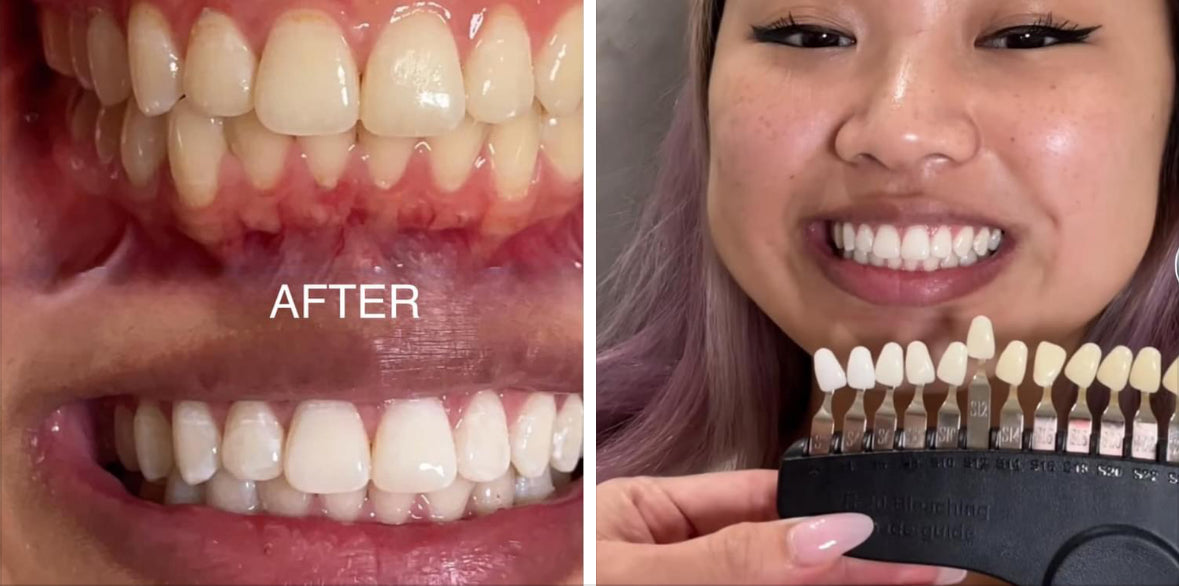 STARLET TEETH WHITENING PEN