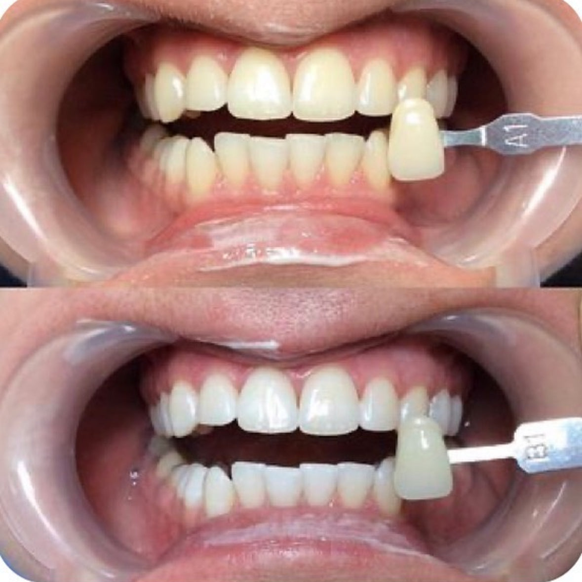 STARLET TEETH WHITENING PEN